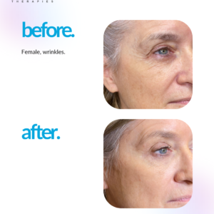 Microchanneling - Microneedling evolved Face + Growth Factor +Hyaluronic mask and LED light