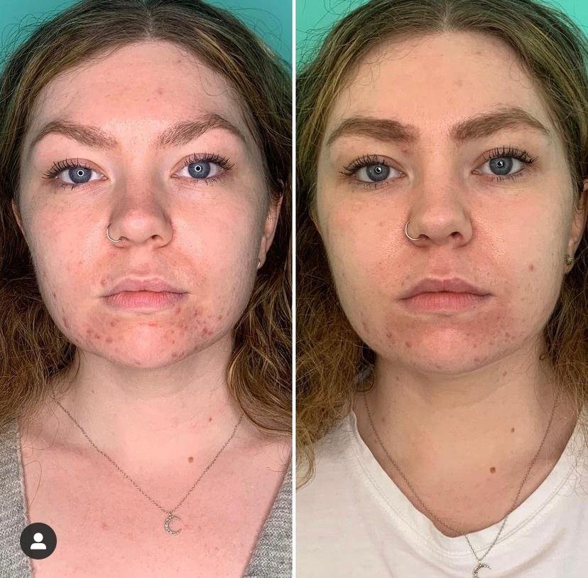 Before and after photos of acne-prone skin after one BioRePeel treatment