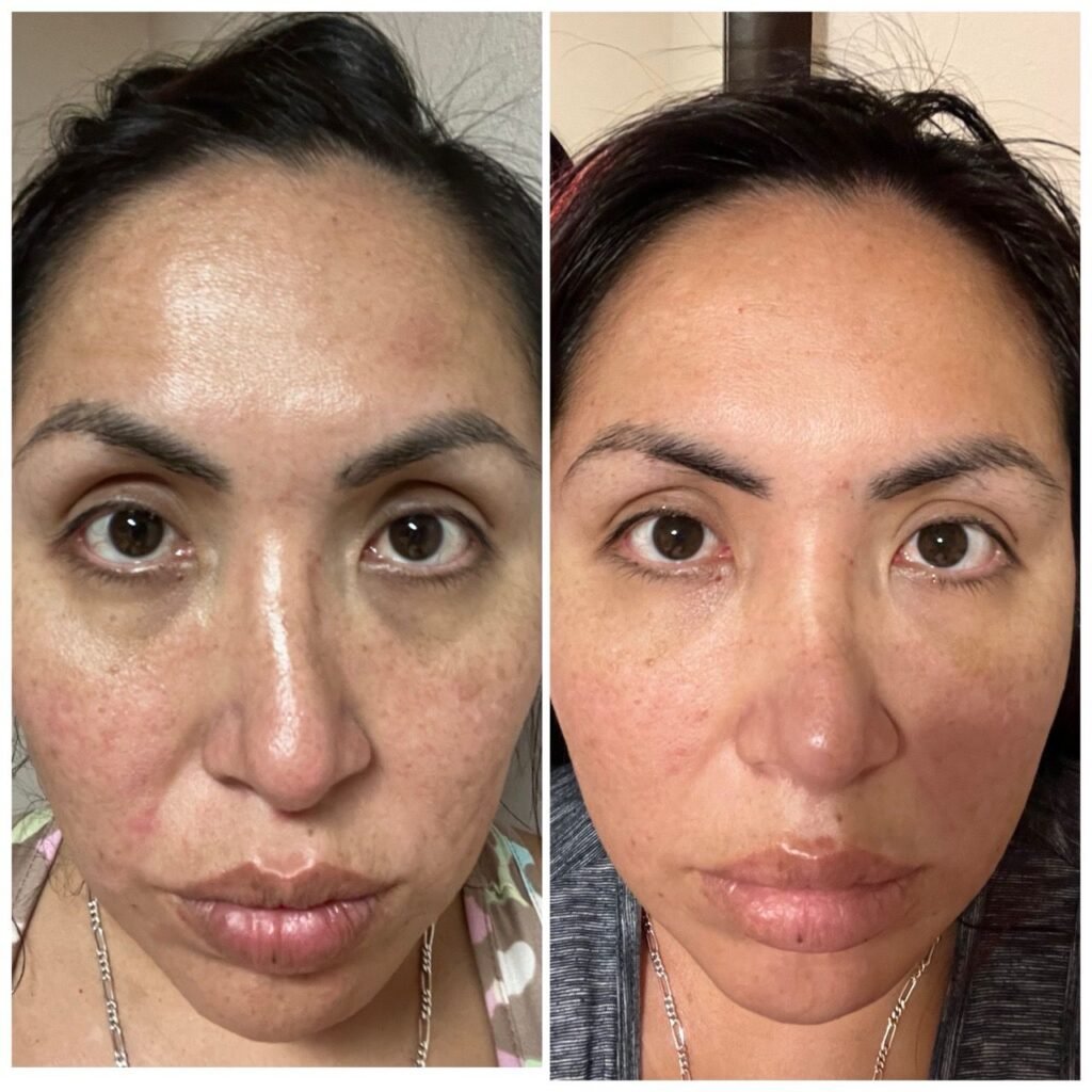 Before and after photos two weeks after one BioRePeel treatment