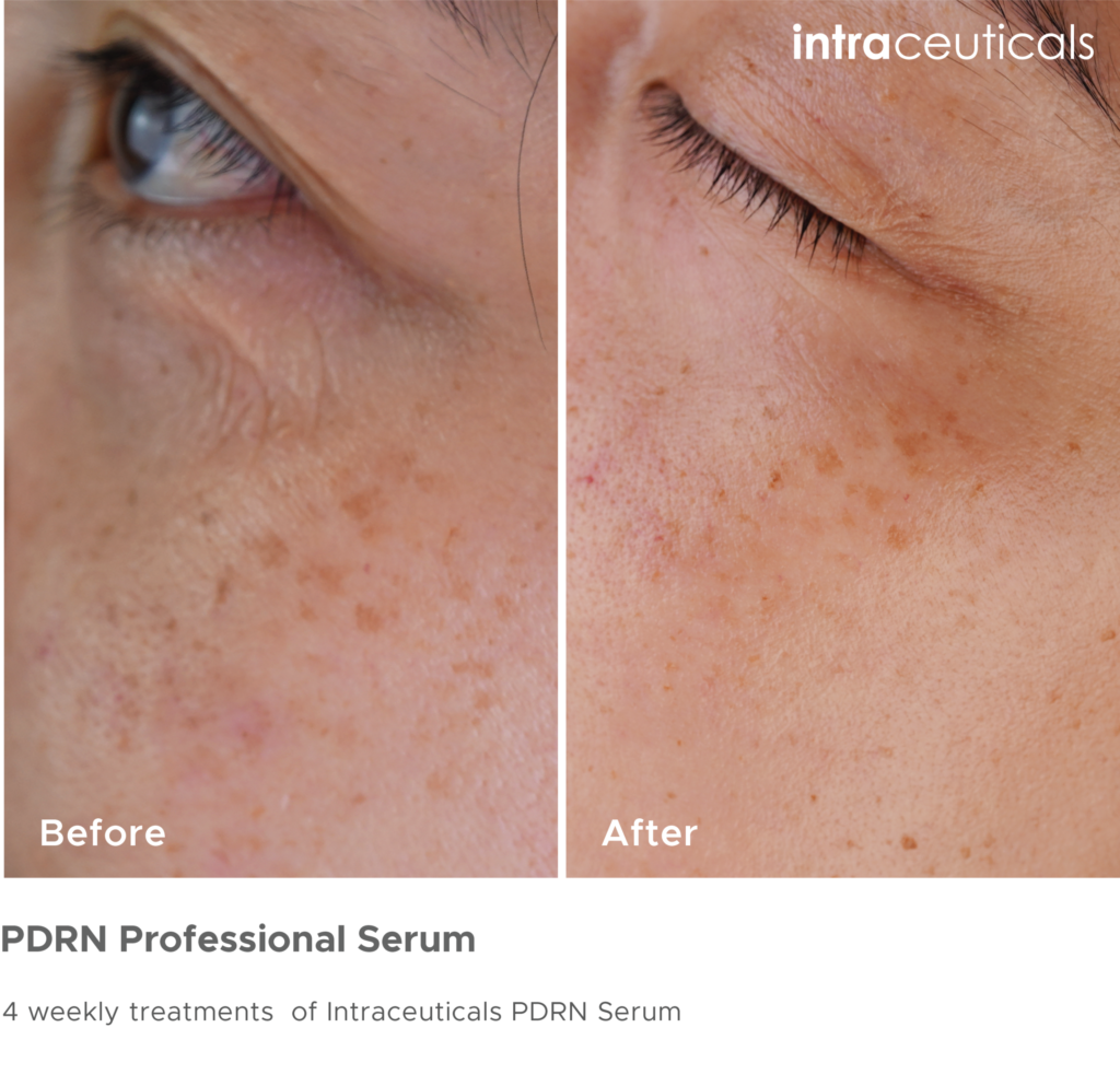 Before and after photos of pigmentation near the eye using PDRN Professional Serum
