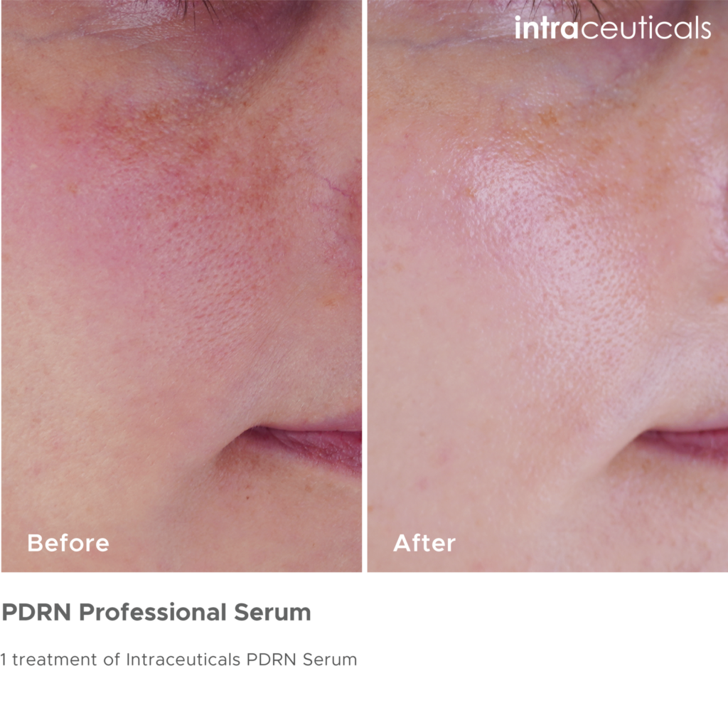 Before and after photos of cheek redness using PDRN Professional Serum