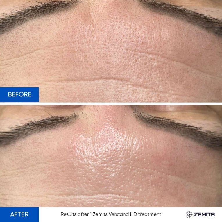 Before and after photos of forehead lines showing smoother skin