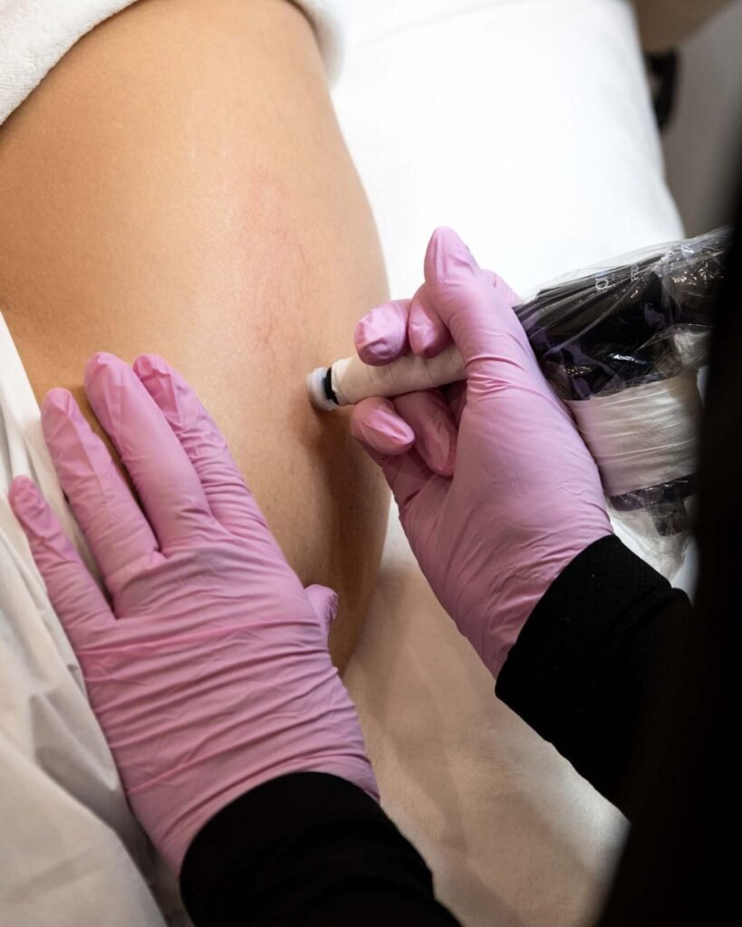 Gloved hands performing a microchanneling treatment on the skin of the arm